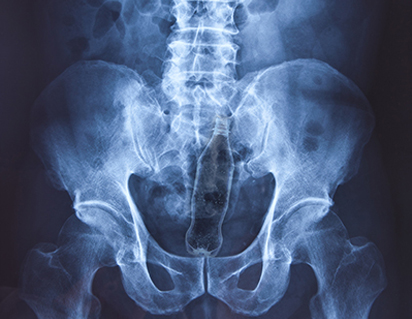 x-ray of a pelvis with a soda bottle inside, from the blog "Booty Alert, what goes up, must come out...."