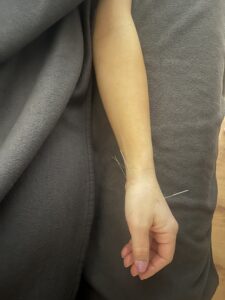 closeup of hand with acupuncture needles